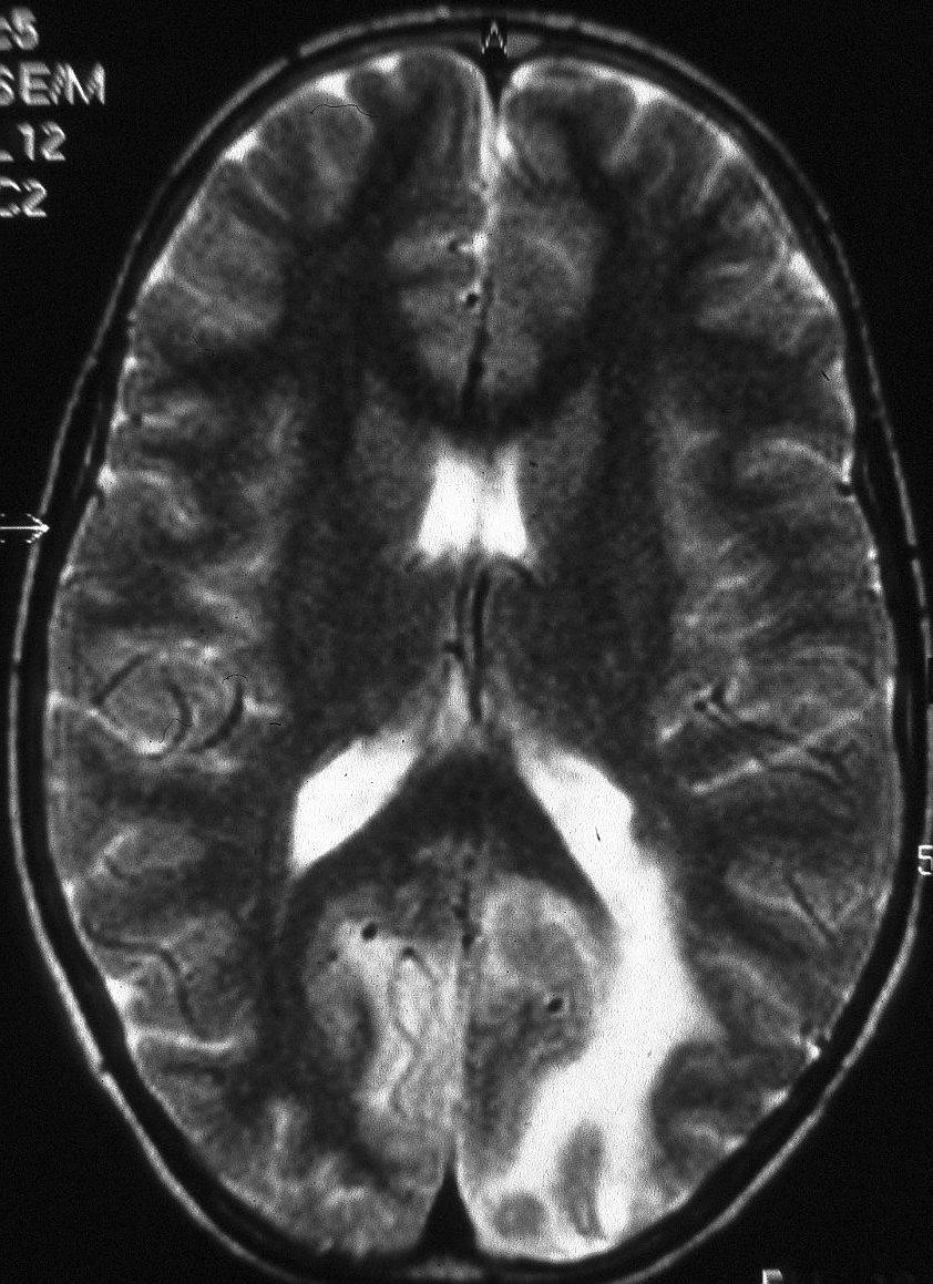MELAS syndrome Myopathy Encephalopathy Lactic