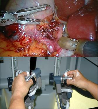using da Vinci YUMC Endoscopic / Robotic Surgery Center
