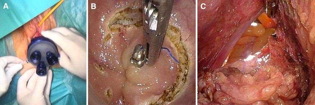 Transanal natural orifice transluminal endoscopic surgery (NOTES) rectal resection: down-to-up total