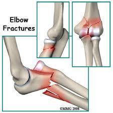 MOI S/S TX Elbow Fractures FOOSHA, or direct blow Possible visible deformity Hemorrhage, muscle spasm, and