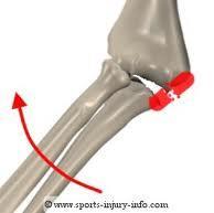 Ulnar Collateral Lig. (UCL) sprain MOI Valgus force from repetitive trauma Tennis, golfing, throwing S/S TX Pn.