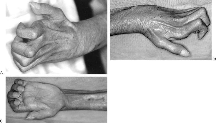 Volkmann s Contracture MOI Complication of serious elbow injury Muscle spasm, swelling, or bone pressure on the brachial artery S/S Pn.