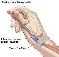Tenosynovitis MOI Repetitive use and overuse of tendons and their sheaths S/S Pn with use, pn w/passive stretching