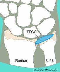Triangular Fibrocartilage Complex Injury (TFCC) MOI S/S TX Forced hyperextension