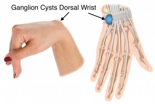Wrist Ganglion MOI S/S TX appears slowly, contains clear mucinous fluid Repeated hyperextension Bump on dorsal wrist Occasional pn,