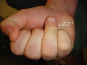 Jersey Finger MOI Most often in the ring finger Grabs a jersey, ruptures flexor tendon S/S DIP joint