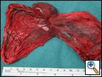 CASE REVIEW Bullectomy via right