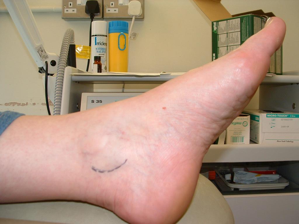 AUTONOMIC Clinical signs Dry skin over feet due to decreased sweating.