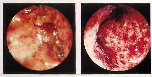 Colonoscopic appearance in