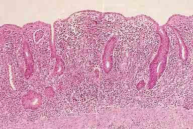 Histology of ulcerative colitis Mucosal