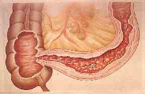 Diagnosis of Crohn s disease Clinical criteria:intestinal, perianal disease Radiologic:segmental, stricture, fistula, longitudinal ulcer