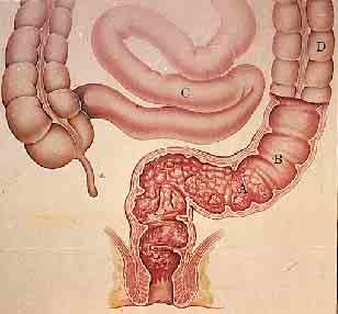 Diagnosis of ulcerative colitis Clinical criteria:intestinal, extraintestinal Endoscopic