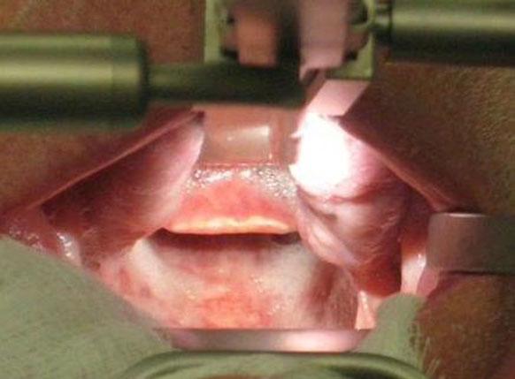 TRANSORAL ROBOTIC TOTAL LARYNGECTOMY The total operative time was 4 hours and 31 minutes. He was discharged on a soft diet on postoperative day 8.