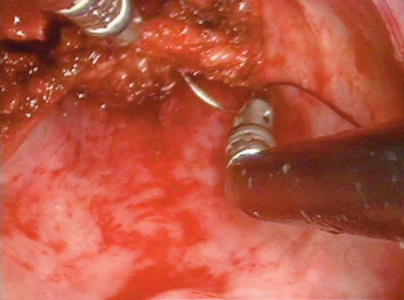 performed robotically, a transcervical approach was used to complete the remainder of the dissection through a 5- cm minilaryngectomy incision (see Figure 3).