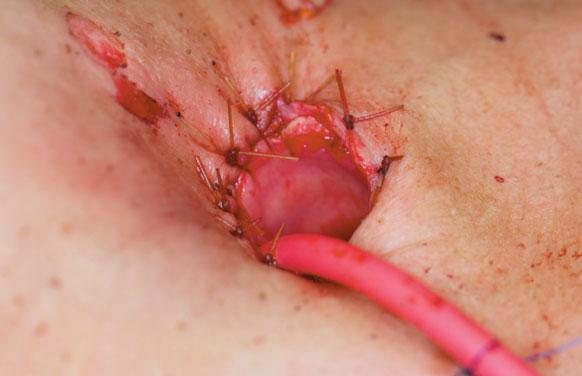 The pharyngotomy was then closed transorally in a T-shape with interrupted 3-0 vicryl sutures using the robot (see Figure 5).