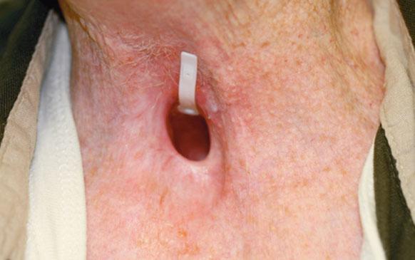 TRANSORAL ROBOTIC TOTAL LARYNGECTOMY FIGURE 7. Photo demonstrating healed stoma 6 months following surgery. Note the absence of incisions and scarring.