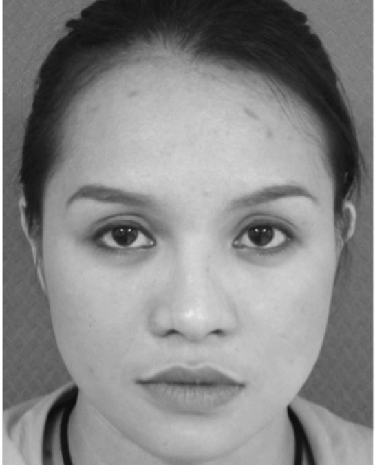 There were four cases of revision rhinoplasty previously using alloplastic materials and one case of trauma. The rest of the cases were primary simple rhinoplasty.