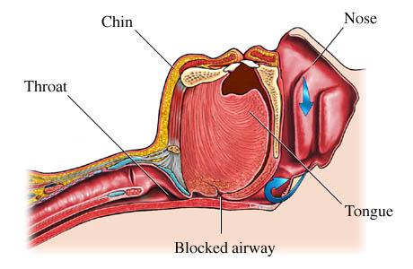 Obstructive Sleep Apnea Partial to complete upper airway obstruction Frequency of respiratory events (Apnea Hypopnea Index or AHI) helps define severity o o o o Normal: AHI < 5