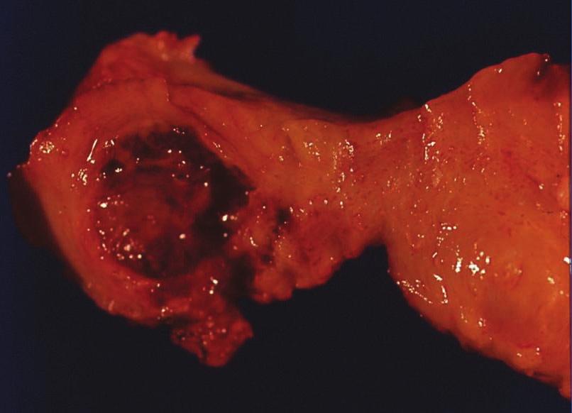 The dark brown colored inner surface of the cyst showed multi-focal, papillary growing, solid and granular masses, measuring up to 0.8 0.8 0.5 cm (Fig. 2).