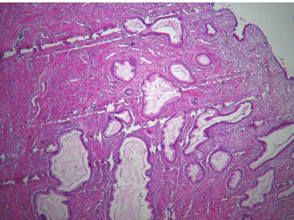 Endometrioid Adenocarcinoma from Uterine Cervix 769 A B C Fig. 3. Histopathological findings. (A) Dilated endocervical glands in the cervix.