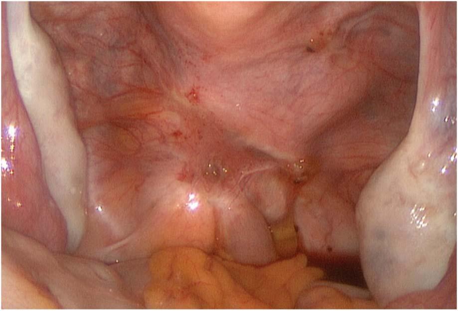 Fig. 1. Deeply infiltrating endometriosis. In this image, the lesion infiltrates the rectum and the rectovaginal space at the level of the cervix. Falcone and Flyckt.
