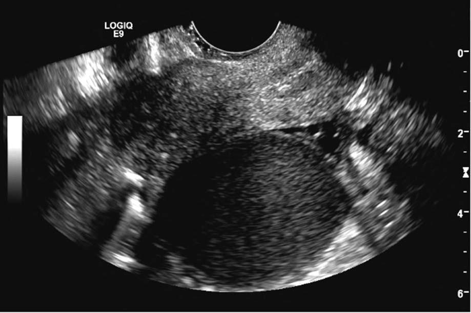 The typical ultrasonographic appearance is shown of a unilocular cyst with homogeneous low-level echogenicity and minimal vascular flow. Falcone and Flyckt. Clinical Management of Endometriosis.