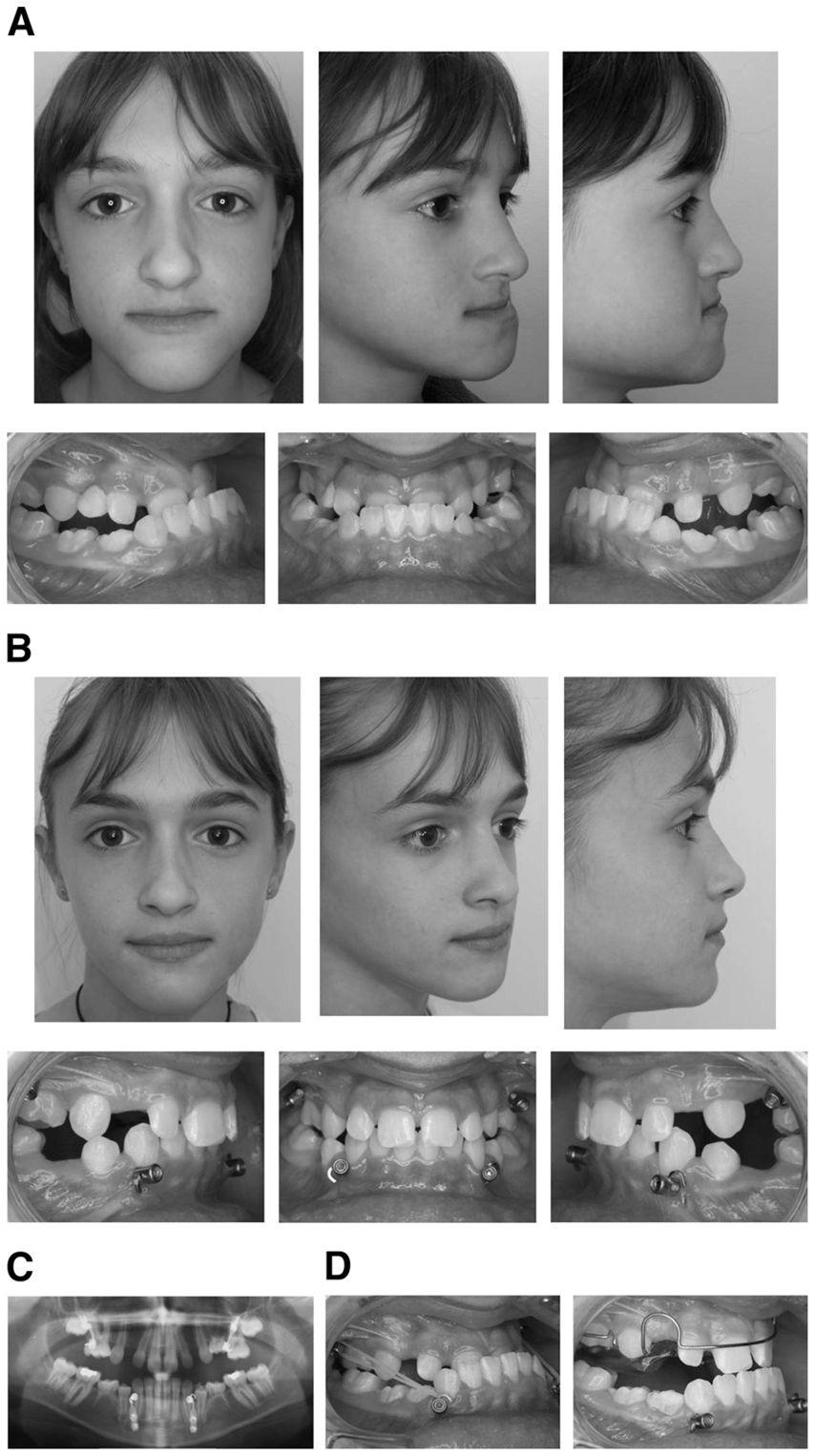 De Clerck et al. Page 8 FIGURE 3. Patient 3. A, Pretreatment facial and intraoral photographs. B, Post-treatment facial and intraoral photographs.