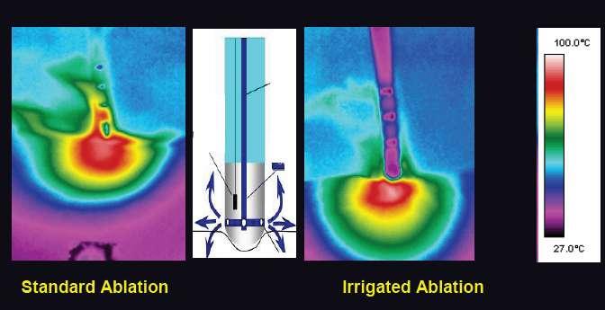 RADIOFREQUENCY ENERGY - Solid 4- or 5-mm electrodes are used for ablation of