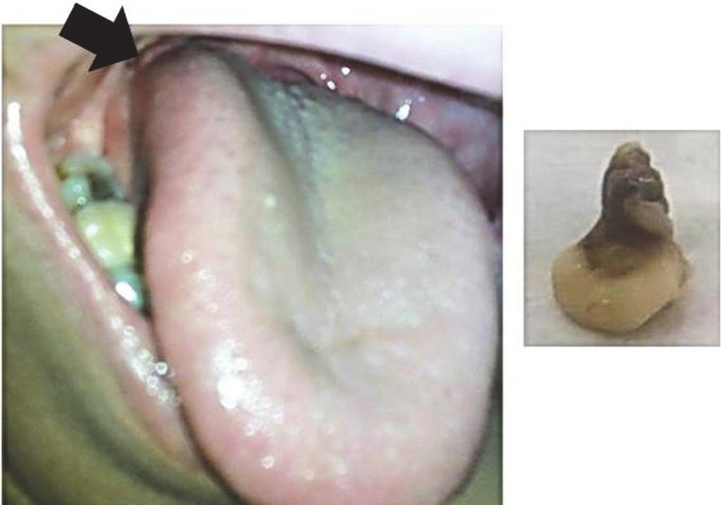 2 Case Reports in Dentistry Table 1: Different types of tongue swellings adapted from Neville et al. [5].