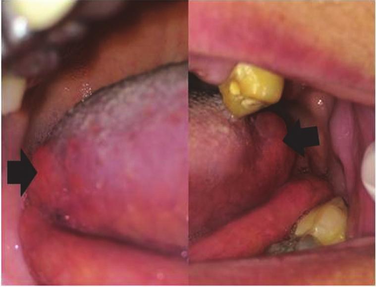 4 Case Reports in Dentistry (a) (b) Figure 3: (a) Clinical aspect of bilateral lymphoid hyperplasia in relation to the posterior part of lateral border of the tongue.