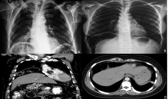 Figure (1 A-D): The transverse colon seems to be interposed between the diaphragm and the liver in chest graphy (A,B), thorax CT (C,D) Figure (2): On the lateral sagittal (A) and coronally (B)