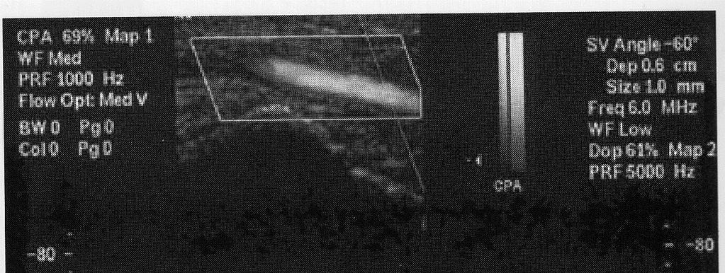 Doppler ultrasound.