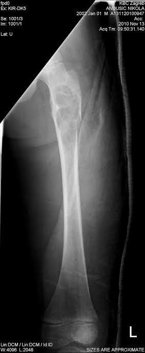 poremećaj strukture i funkcije kolagena tipa I, a dovodi do osteopenije, krhkosti kostiju te sklonosti prijelomima i pri neznatnim traumama.