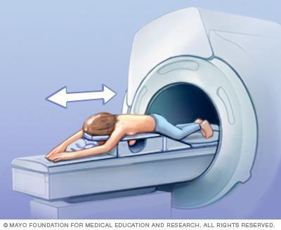 Screening breast MRI has been found
