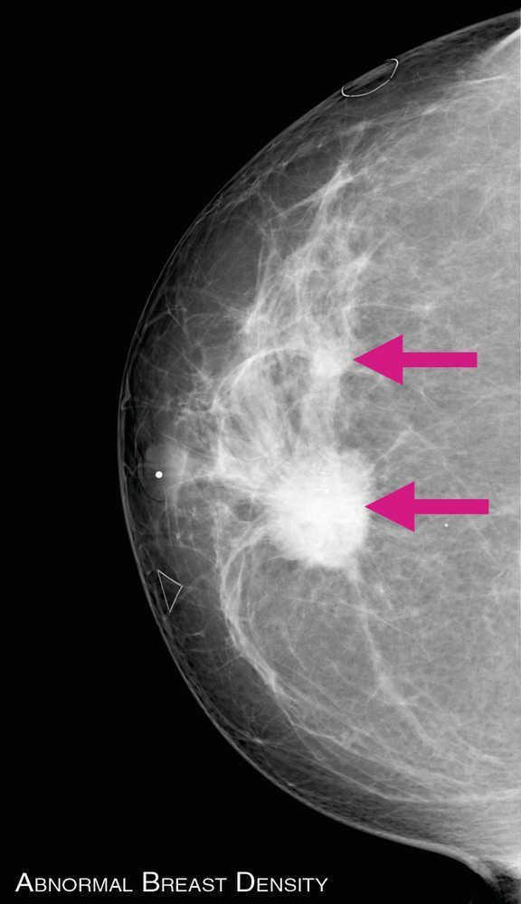 Data is limited on the optimal frequency for performing mammography.
