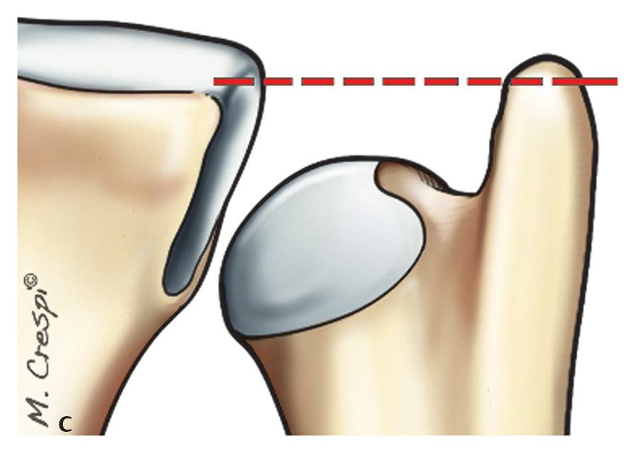 The resulting injuries appear in succession over time: perforation of the radioulnar disk of the triangular fibrocartilage complex (TFCC) ligament, impingement between the distal ulna and medial