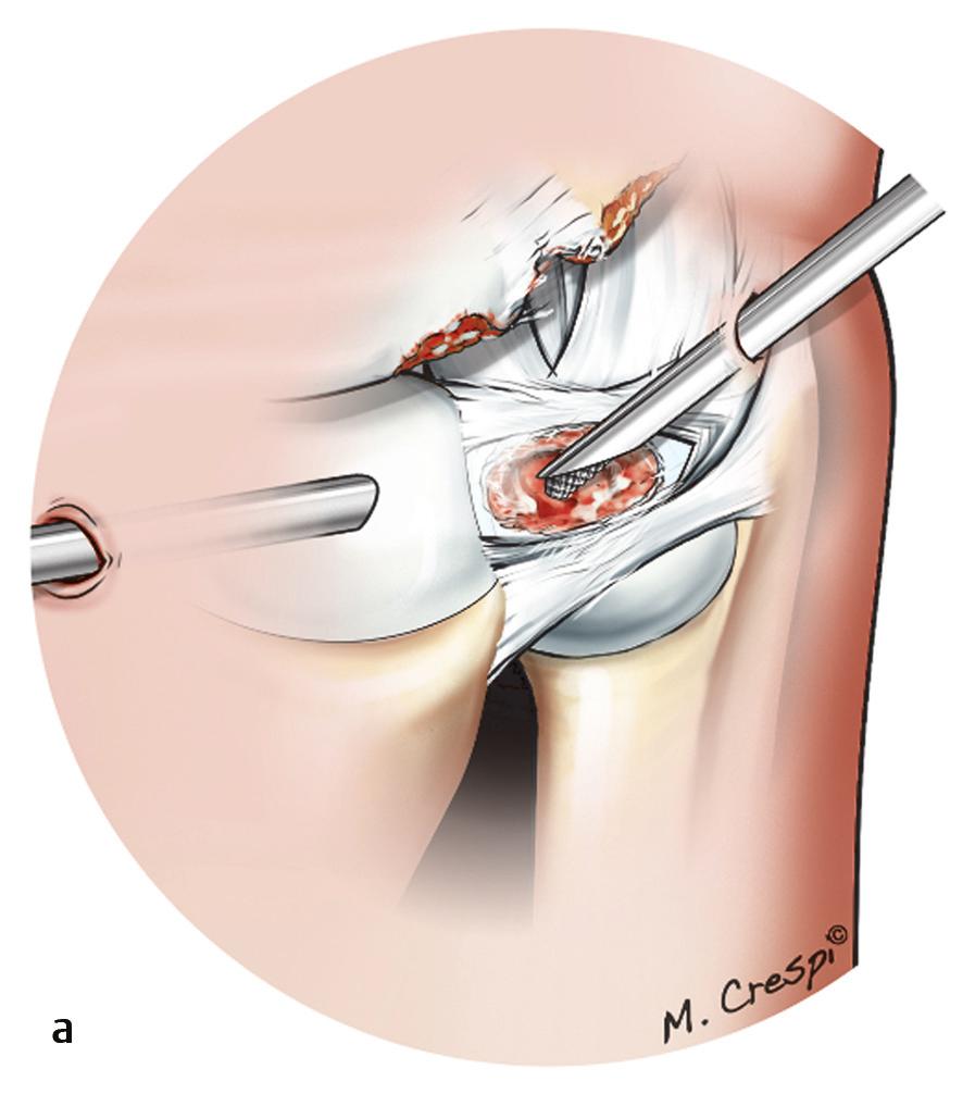 4 Arthroscopic view of damaged ulnar head cartilage through the central triangular fibrocartilage complex (TFCC)