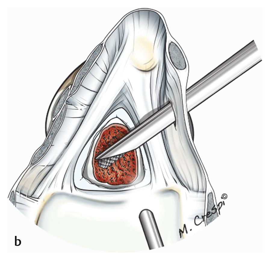 3 Drawing of central debridement of the triangular fibrocartilage complex (TFCC) using basket forceps.