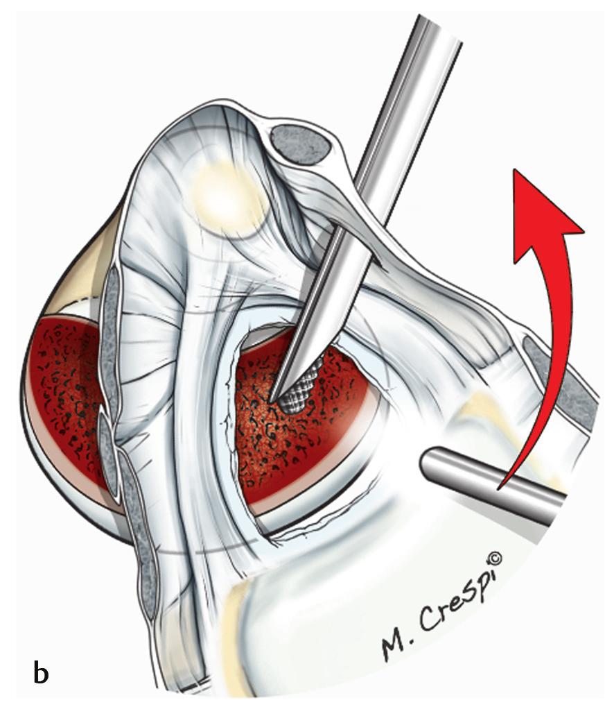 resection step, the distal radioulnar joint (DRUJ) must be preserved (Fig. 12.7a c). At the end of this step, the articular surface has undergone a helicoidally oblique osteotomy.