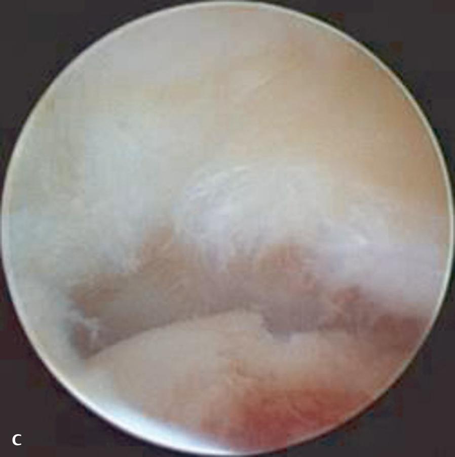 b Arthroscopic view of the intact radioulnar joint after