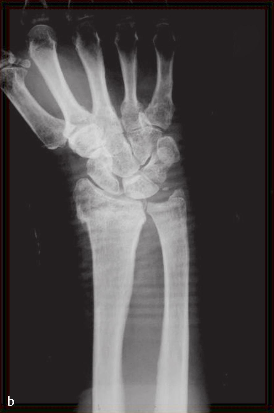 10a, b a Radiograph of ulnar impaction syndrome secondary to a