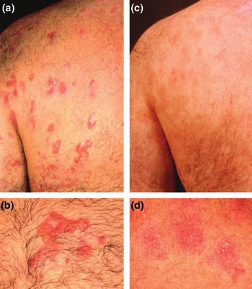 Figure 1 (a, b) Disseminated erosions and blisters on the back of patient no. 26 with epidermolysis bullosa acquisita before rituximab had been initiated.