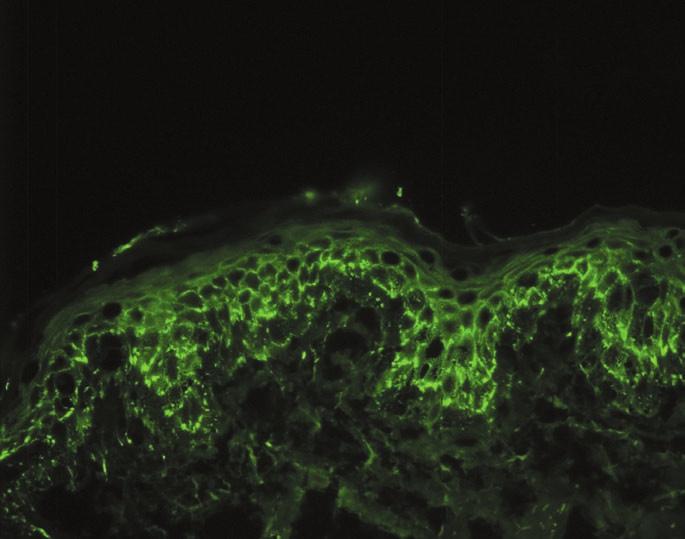 Diagnostic immunopathology Fig. 3 Intercellular staining of IgG in a patient with pemphigus vulgaris using direct immunofluorescence. (fluorescence microscopy, original magnification x 200).