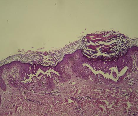 Dermatol Ther (2011) 1(2):31-35. 33 Figure 3. Keratotic brown-colored papules in the infra-mammary folds The patient was treated with topical retinoid, which led to a partial clearance.