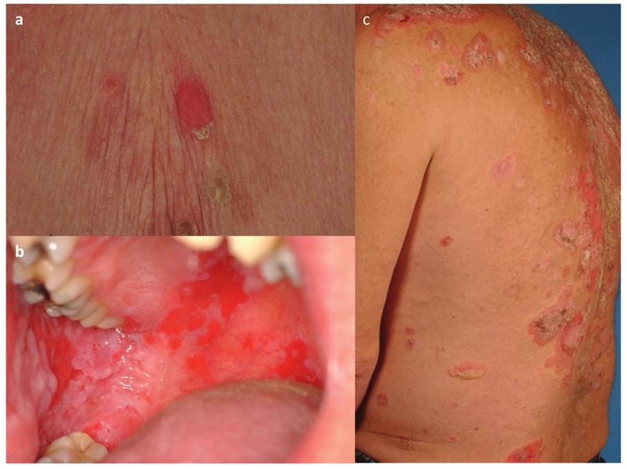 Pemphigus: disease and pathogenesis distribution on face, scalp and upper trunk. In central and southern Brazil, an endemic form of pemphigus called Fogo selvagem (wild fire) is found.