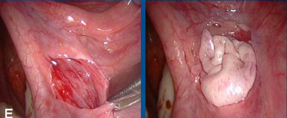 Orthotopic Transplantation Ovarian Fossa