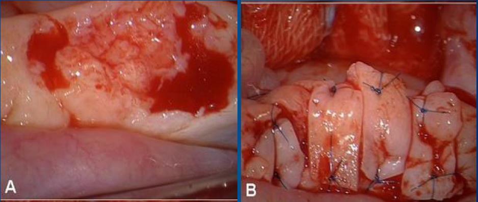 Orthotopic Transplantation Contralateral