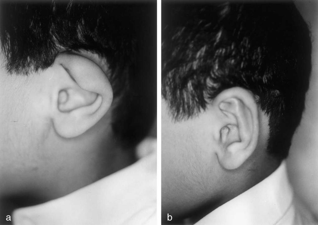 392 M.M. Al-Qattan Figure 4 Correction in a 6-year-old boy. (a) Pre-operative appearance. (b) Post-operative result at 6 months. Note the deficiency in both the scapha and triangular fossa.
