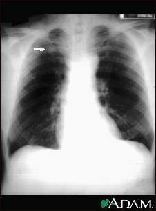 Pulmonary nodule -