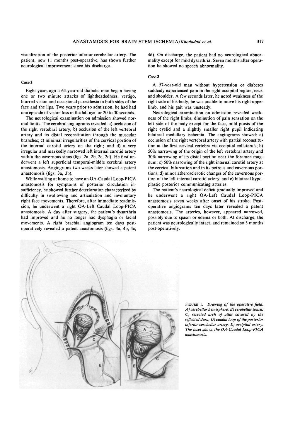 ANASTAMOSIS FOR BRAIN STEM ISCHEMIA/Khodadad et al. visualization of the posterior inferior cerebellar artery.